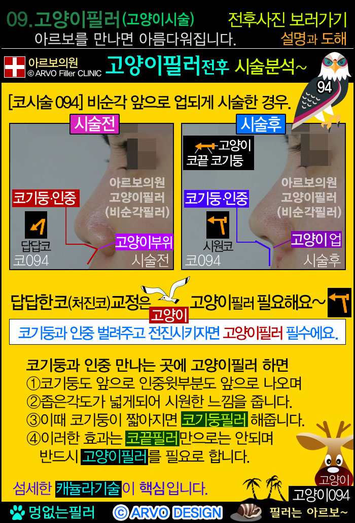 옆광대필러,볼살필러,볼필러,옆볼필러 ,옆볼살필러,얼굴살필러,볼꺼짐필러